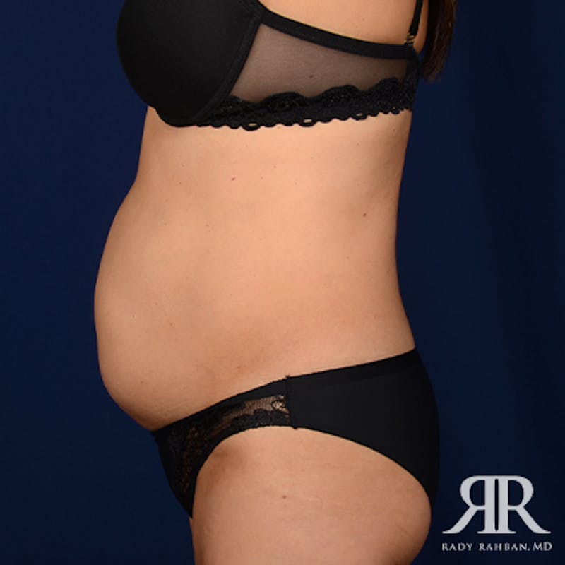 Severe Diastasis Recti Before & After Gallery - Patient 310530 - Image 5