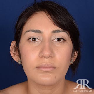 Ethnic Rhinoplasty Before & After Gallery - Patient 913976 - Image 2