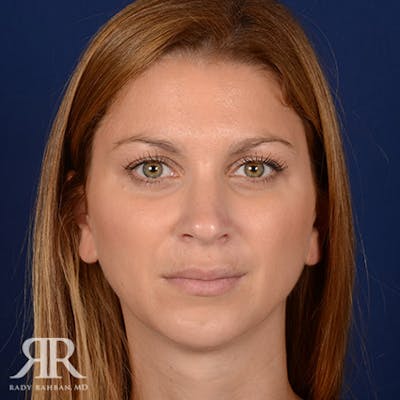 Female Rhinoplasty Before & After Gallery - Patient 165334 - Image 2