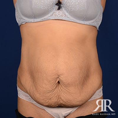 Severe Diastasis Recti Before & After Gallery - Patient 354173 - Image 1