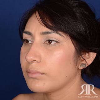 Ethnic Rhinoplasty Before & After Gallery - Patient 913976 - Image 4