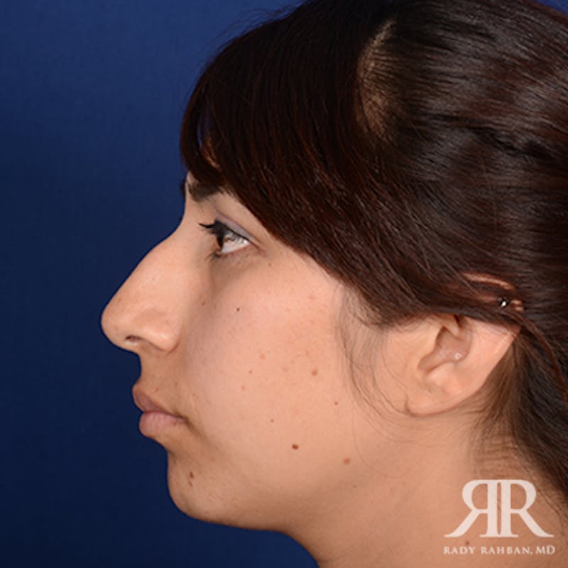 Ethnic Rhinoplasty Before & After Gallery - Patient 913976 - Image 5