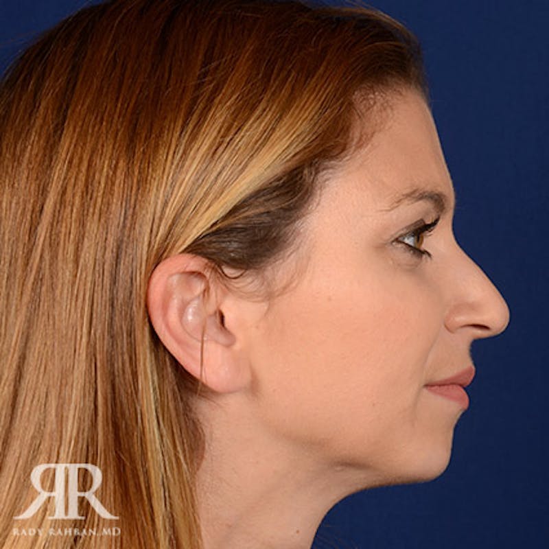 Female Rhinoplasty Before & After Gallery - Patient 165334 - Image 5