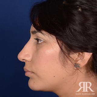 Ethnic Rhinoplasty Before & After Gallery - Patient 913976 - Image 6