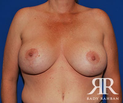 Breast Lift Before & After Gallery - Patient 186702 - Image 2