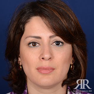 Ethnic Rhinoplasty Before & After Gallery - Patient 542306 - Image 2