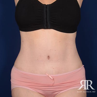 Severe Diastasis Recti Before & After Gallery - Patient 209146 - Image 2