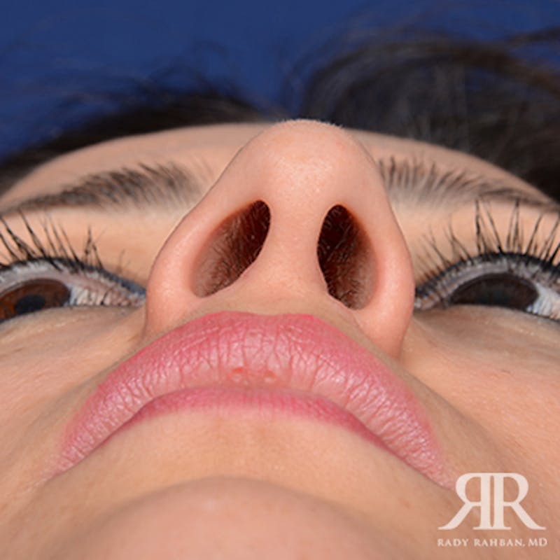 Ethnic Rhinoplasty Before & After Gallery - Patient 542306 - Image 7