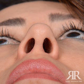 Ethnic Rhinoplasty Before & After Gallery - Patient 542306 - Image 8