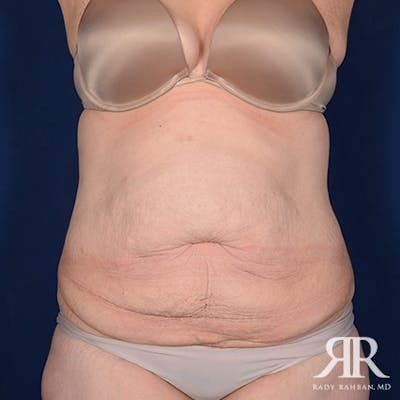 Tummy Tuck Before & After Gallery - Patient 315807 - Image 1