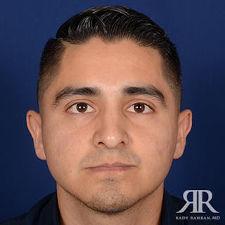 Ethnic Rhinoplasty Before & After Gallery - Patient 393777 - Image 2
