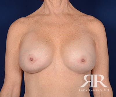 Corrective Breast Surgery Before & After Gallery - Patient 886763 - Image 2