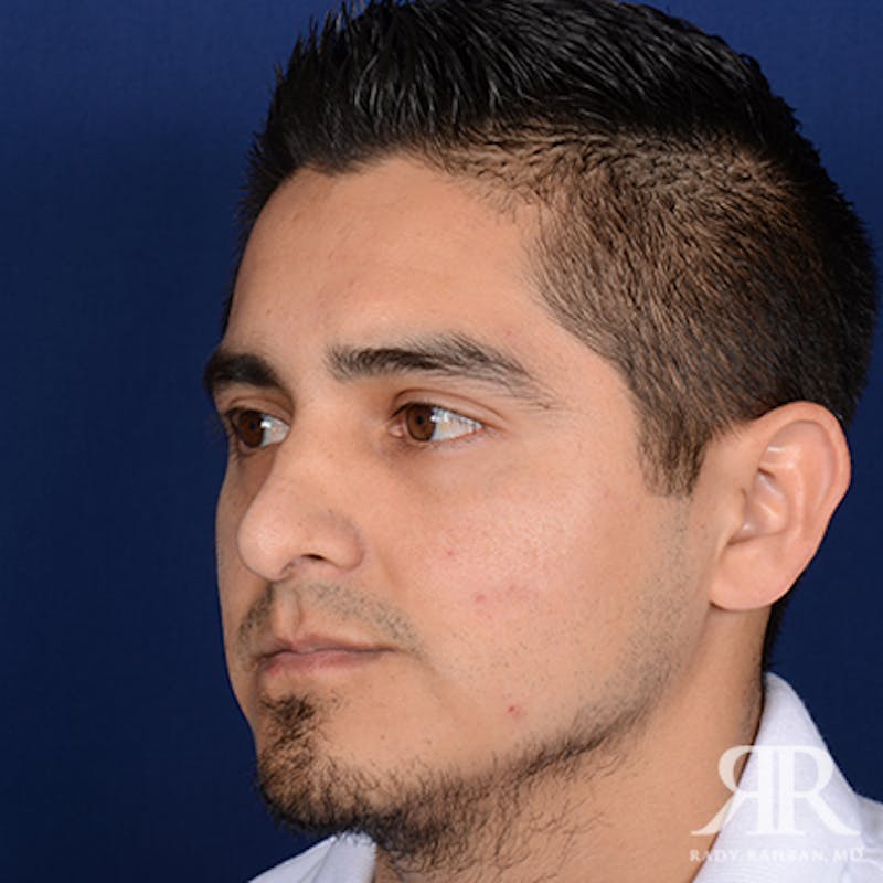 Ethnic Rhinoplasty Before & After Gallery - Patient 393777 - Image 3