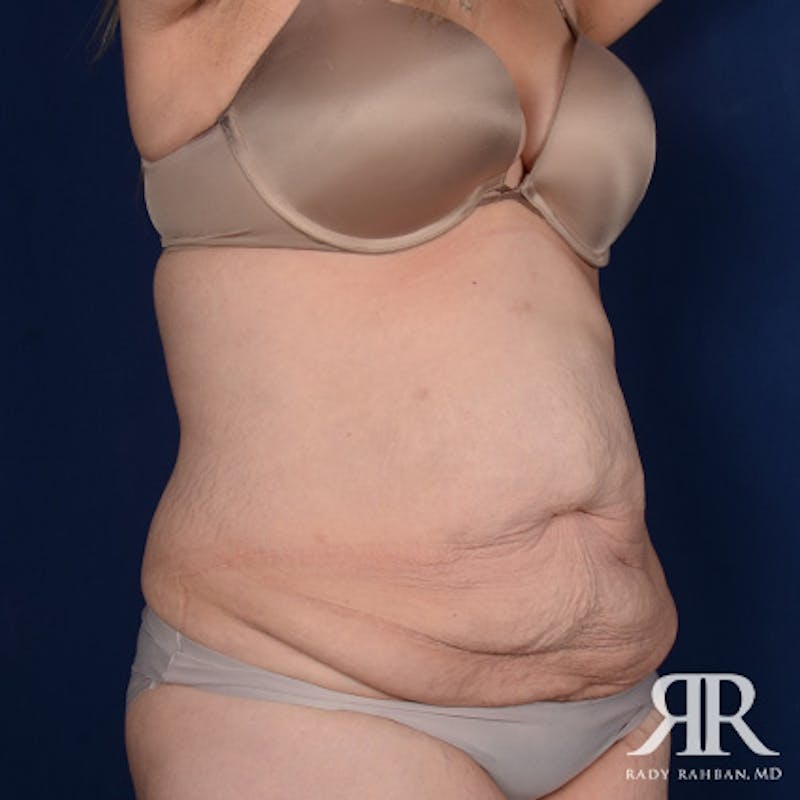 Tummy Tuck Before & After Gallery - Patient 315807 - Image 3
