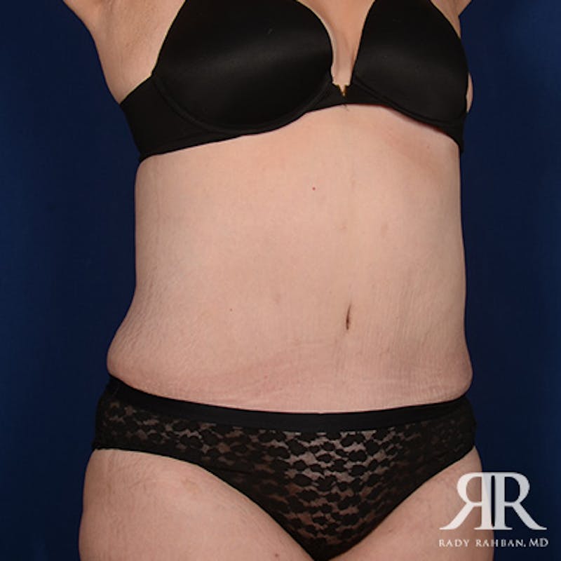 Tummy Tuck Before & After Gallery - Patient 315807 - Image 4