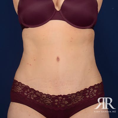 Severe Diastasis Recti Before & After Gallery - Patient 262523 - Image 2