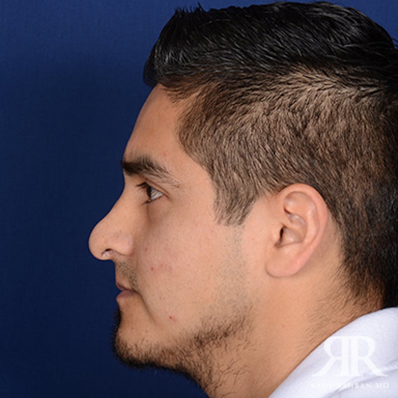 Ethnic Rhinoplasty Before & After Gallery - Patient 393777 - Image 5