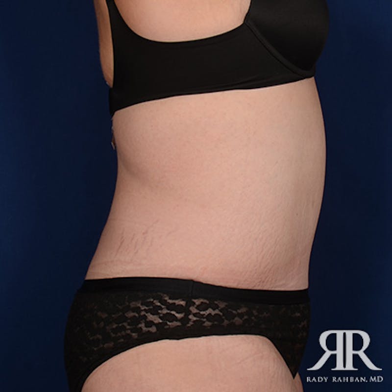 Tummy Tuck Before & After Gallery - Patient 315807 - Image 6
