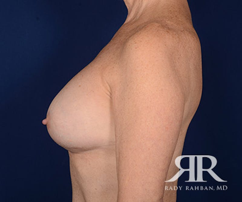 Corrective Breast Surgery Before & After Gallery - Patient 886763 - Image 6