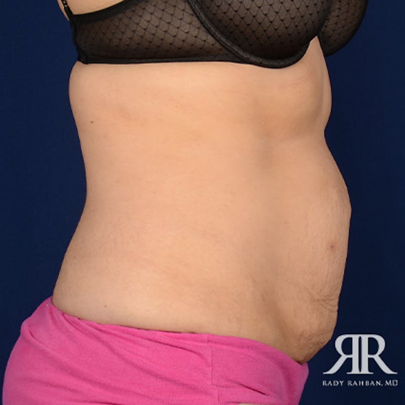 Severe Diastasis Recti Before & After Gallery - Patient 262523 - Image 5