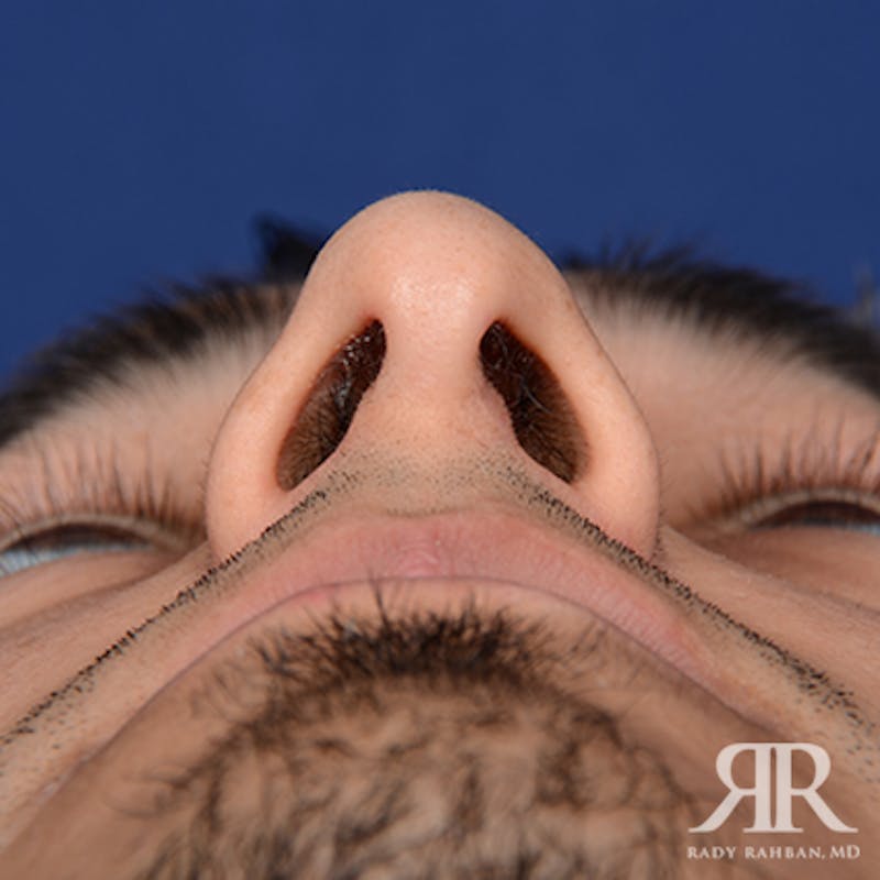 Ethnic Rhinoplasty Before & After Gallery - Patient 393777 - Image 7