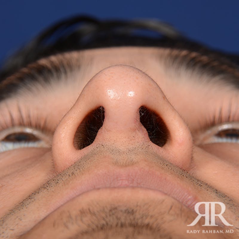 Ethnic Rhinoplasty Before & After Gallery - Patient 393777 - Image 8