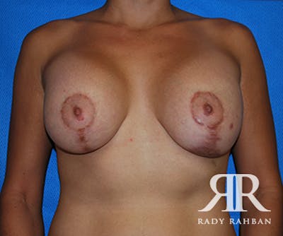 Corrective Breast Surgery Before & After Gallery - Patient 241891 - Image 1