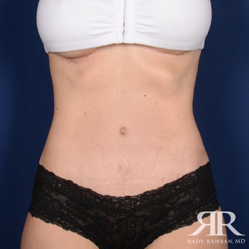 Tummy Tuck Before & After Gallery - Patient 342853 - Image 2