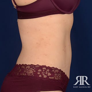 Severe Diastasis Recti Before & After Gallery - Patient 262523 - Image 6
