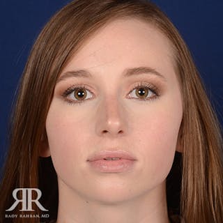 Female Rhinoplasty Before & After Gallery - Patient 220655 - Image 2