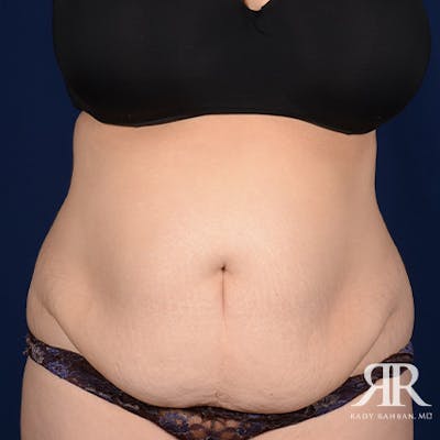 Severe Diastasis Recti Before & After Gallery - Patient 321534 - Image 1