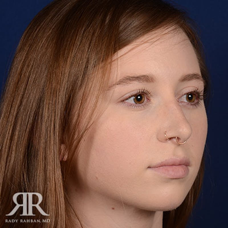 Female Rhinoplasty Before & After Gallery - Patient 220655 - Image 3