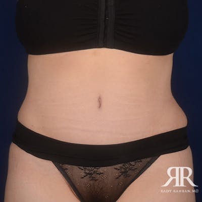 Severe Diastasis Recti Before & After Gallery - Patient 321534 - Image 2