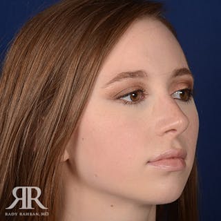 Female Rhinoplasty Before & After Gallery - Patient 220655 - Image 4