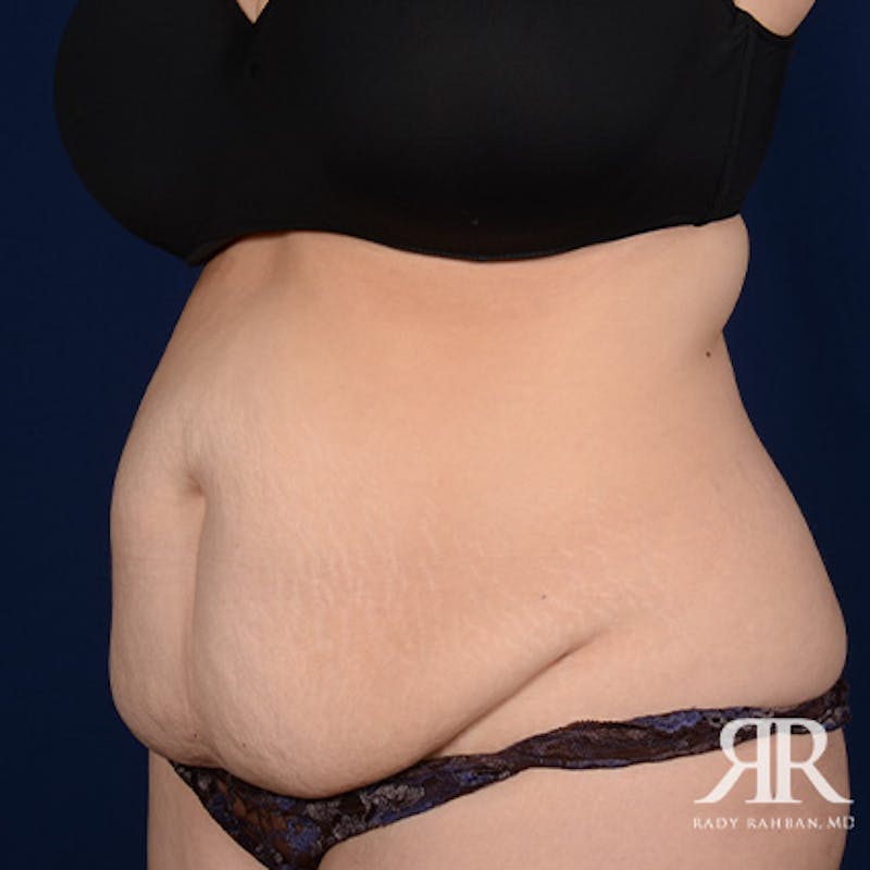 Severe Diastasis Recti Before & After Gallery - Patient 321534 - Image 3