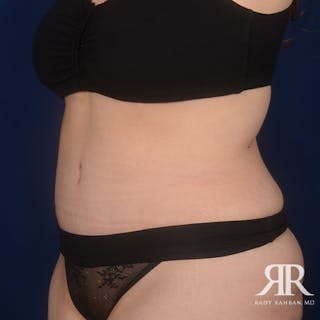 Severe Diastasis Recti Before & After Gallery - Patient 321534 - Image 4