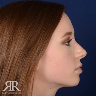 Female Rhinoplasty Before & After Gallery - Patient 220655 - Image 6