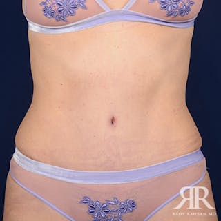 Tummy Tuck Before & After Gallery - Patient 112629 - Image 2