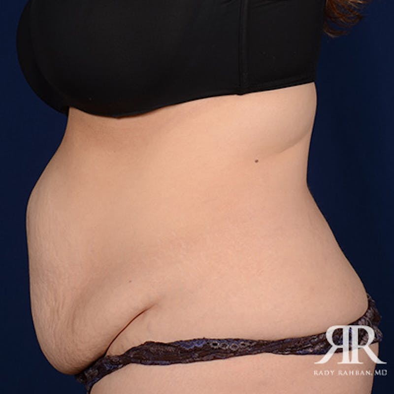Severe Diastasis Recti Before & After Gallery - Patient 321534 - Image 5