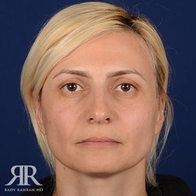 Female Rhinoplasty Before & After Gallery - Patient 279998 - Image 1