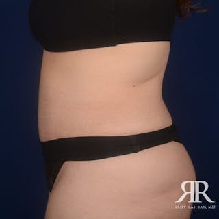 Severe Diastasis Recti Before & After Gallery - Patient 321534 - Image 6