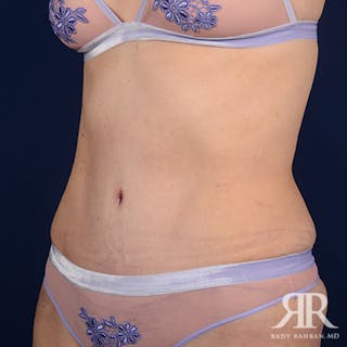 Tummy Tuck Before & After Gallery - Patient 112629 - Image 4