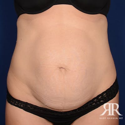 Severe Diastasis Recti Before & After Gallery - Patient 414518 - Image 1