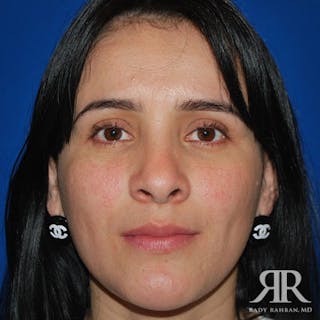 Ethnic Rhinoplasty Before & After Gallery - Patient 412462 - Image 2