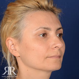 Female Rhinoplasty Before & After Gallery - Patient 279998 - Image 4