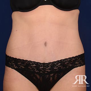 Severe Diastasis Recti Before & After Gallery - Patient 414518 - Image 2