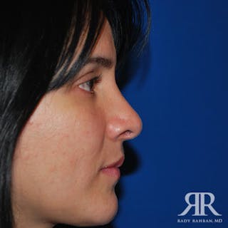 Ethnic Rhinoplasty Before & After Gallery - Patient 412462 - Image 4