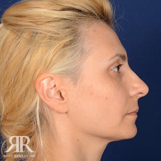 Female Rhinoplasty Before & After Gallery - Patient 279998 - Image 6