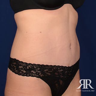 Severe Diastasis Recti Before & After Gallery - Patient 414518 - Image 4