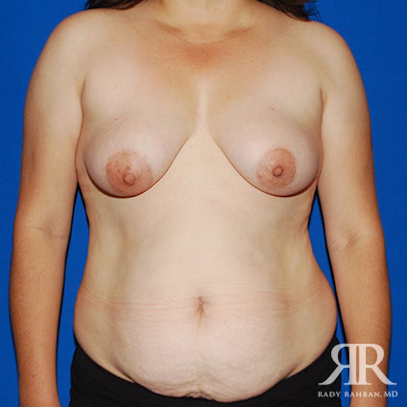 Mommy Makeover Before & After Gallery - Patient 325638 - Image 1
